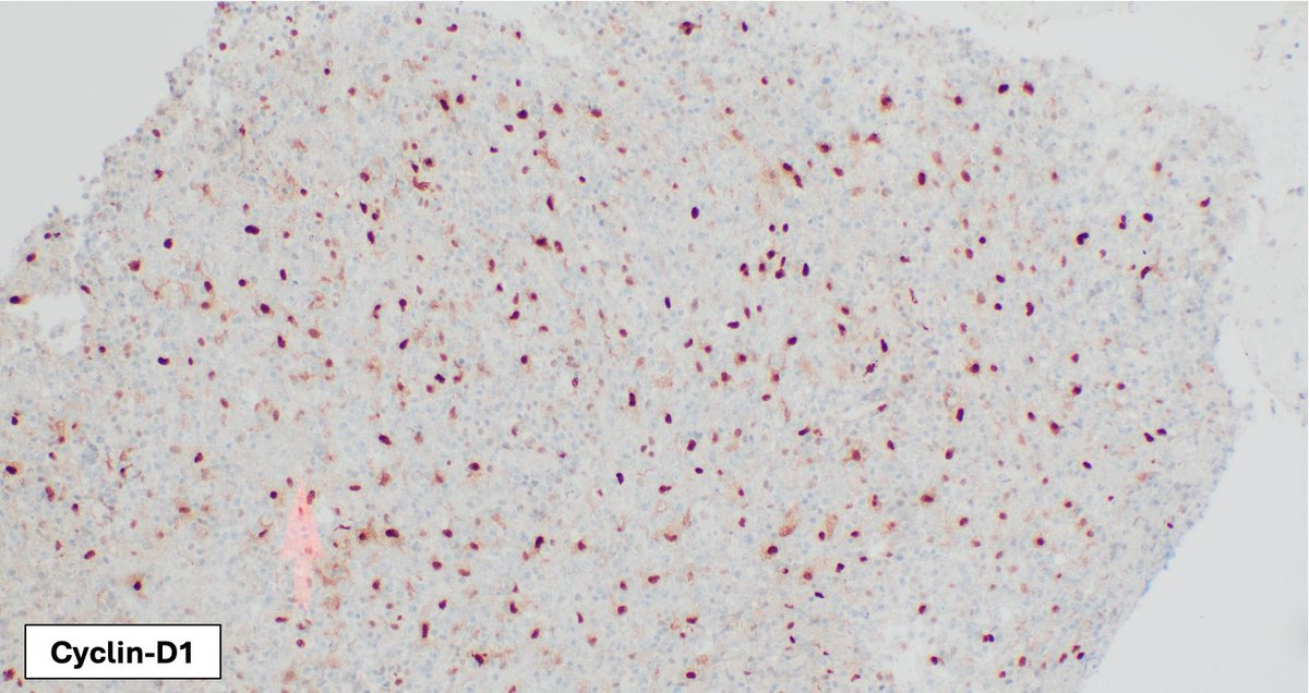 Primary large B-cell lymphoma of the CNS: Cyclin-D1 highlights endothelial cells in brain tissue, however its pattern of expression could be misinterpreted as positivity in neoplastic cells. Comparison to MUM1 & PAX5 is helpful to avoid this pitfall #hemepath #lymsm #PathX