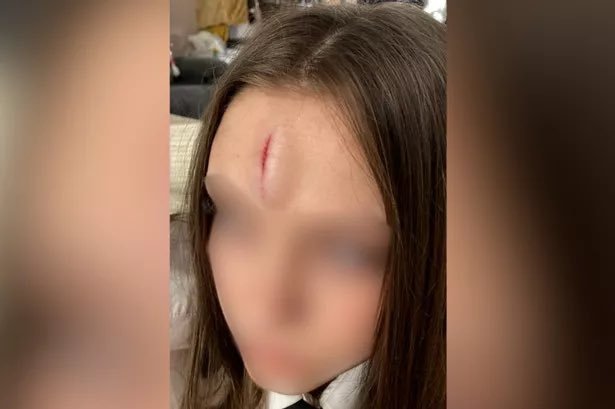 While @IndiaWilloughby @ChristieElanCan accuse @KemiBadenoch of lying about schoolgirls being afraid of mixed sex toilets, here’s a pic of the injury a 13yr old suffered at Caludon Castle School in Coventry when a boy kicked the cubicle door in because he wanted to a photo of her