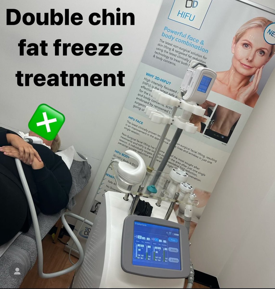 Double chin reduction by freezing the fat under the chin. Painless and with no downtime! 

#nonsurgical #doublechintreatment #fatfreezing #medicalaesthetics #seeaprofessional #awardwinning #willington #derby #derbyshire