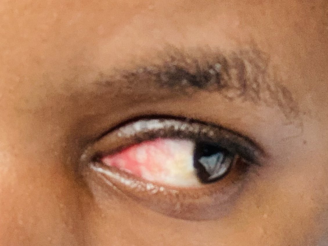 Any quick remedy for this red eye disease??