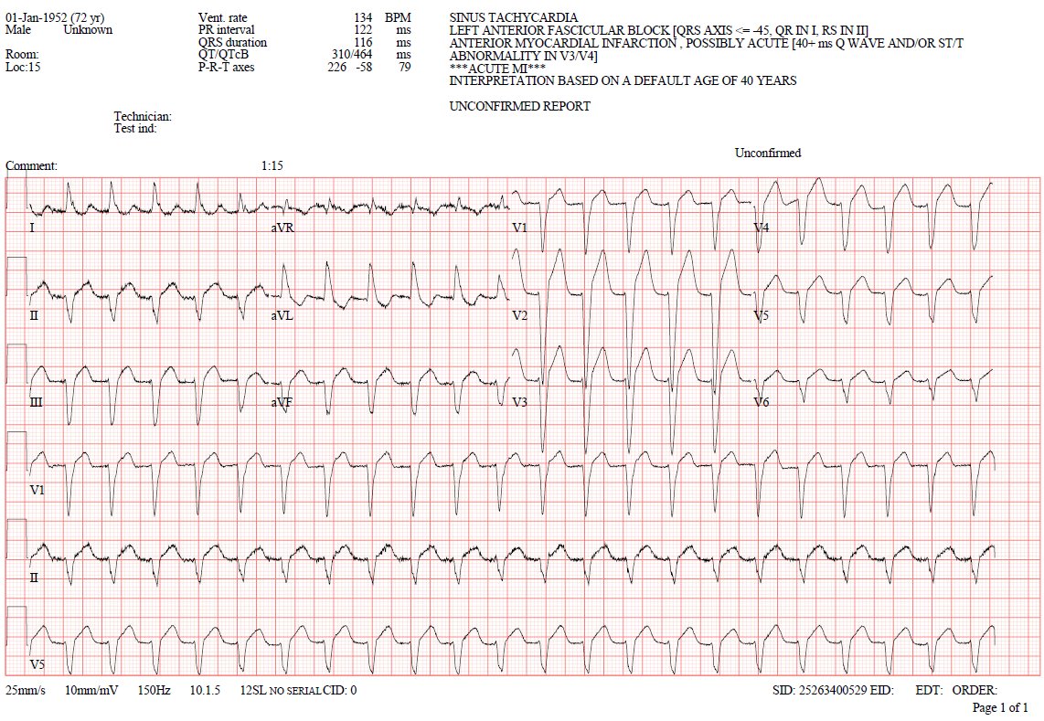 72 years old male brought in to ED with palpitations. What is the rhythm?