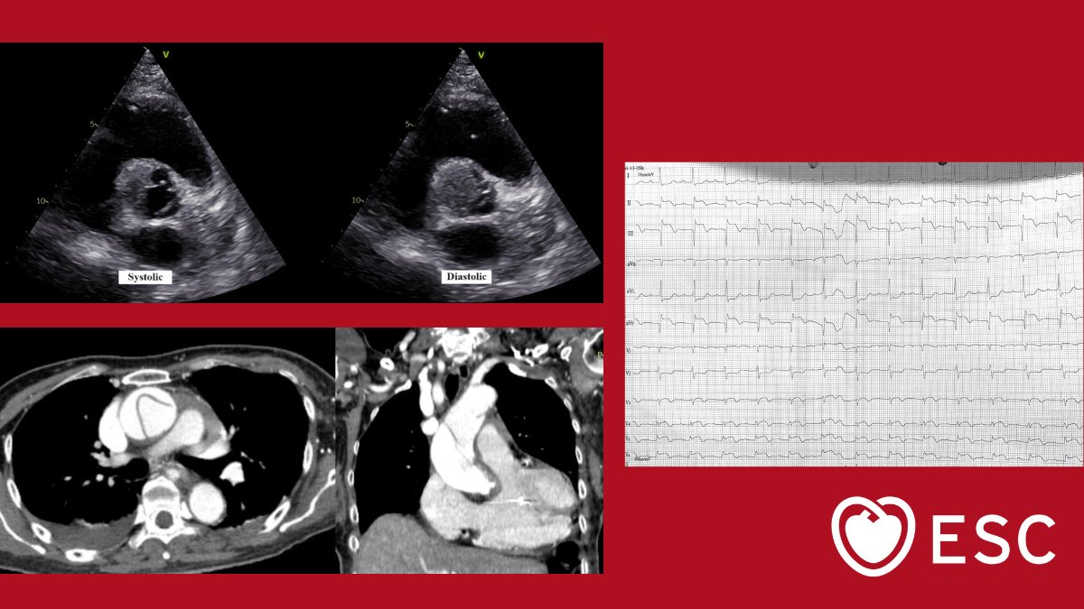 #ImageOfTheWeek by Willis Kwandou, Agnes Lucia Panda and Gratiani Eben H. Reppi from the Department of Cardiology & Vascular Medicine Sam Ratulangi University Prof. Dr. R. D. Kandou General Hospital, Manado, Indonesia What is the most probable diagnosis? bit.ly/3y6oSQc