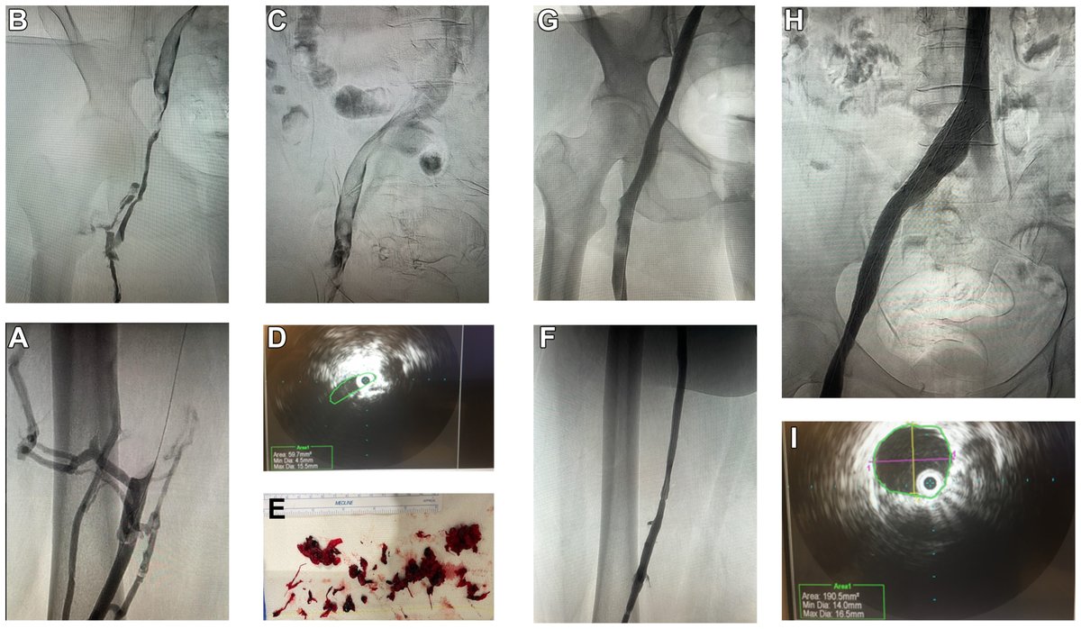 Todays #VenousPhotoFriday highlights newly published research from @TweetPimaHeart! Check out their data on ambulatory management of acute iliofemoral DVT w/ May-Thurner syndrome! jvsvenous.org/article/S2213-… #VenousEd #VascSurg #irad