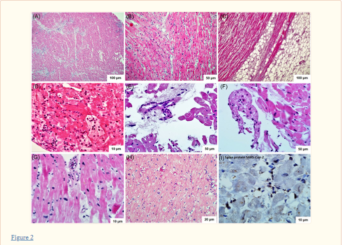 Chronic biopsy proven post‐COVID myoendocarditis with SARS‐Cov‐2 persistence and high level of antiheart antibodies 🔥A very interesting study (2022) that needed a revisit! ➡️Study: 14 post-C19 patients (50y+/-10y’s, youngest: 35y) were investigated that presented themselves