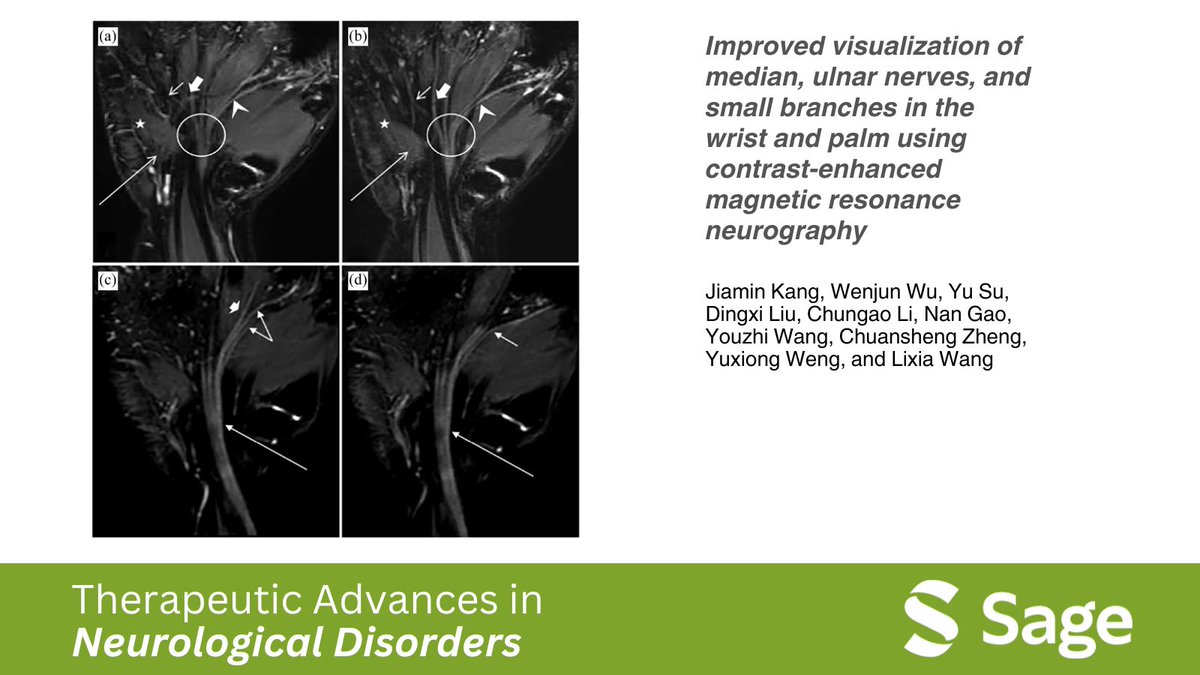 🌟 Explore the cutting-edge technique of contrast-enhanced magnetic resonance neurography (ceMRN) for enhanced nerve visualization in the wrist and palm. Can this method revolutionize diagnostic imaging for hand lesions? Read more: journals.sagepub.com/doi/full/10.11…