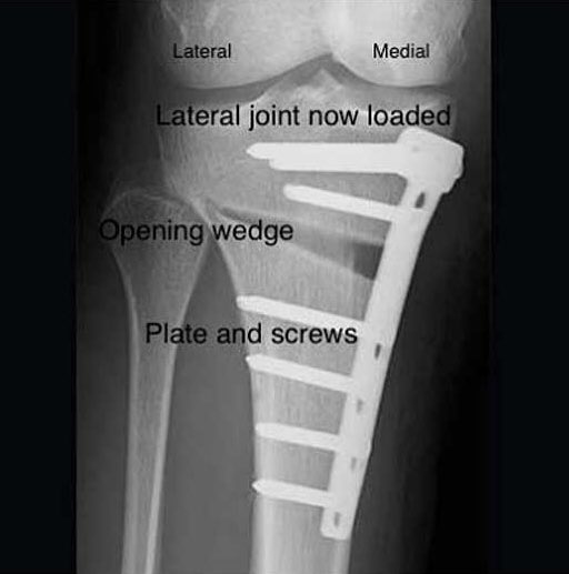 #osteotomy #arthrits #osteoarthritis #versusarthritis @VersusArthritis