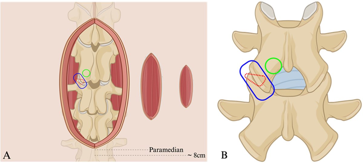 pubmed.ncbi.nlm.nih.gov/38673544/ In a world of personalized medicine,spine surgery should also be personalized. @PeterDrossop,Favour Ononogbu-uche , @QTabarestani,Chuan-Ching Huang,Mounica Paturu, @Amwab,Wilson Ray,Chris Shaffrey,Rory Goodwin, @drericksonspine , JohnChi @DukeSpine