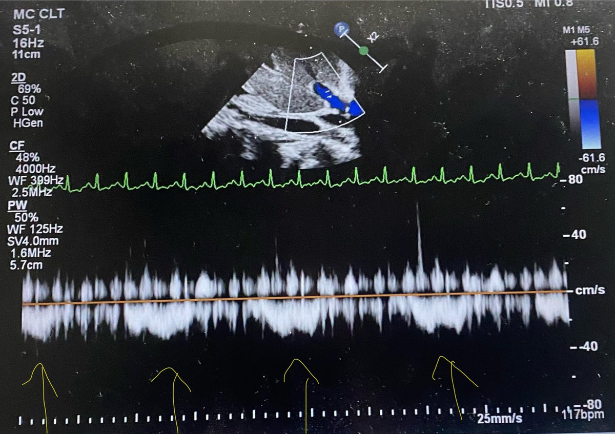 Hepatic Vein Doppler for fellows. Hepatic vein flow in a post operative patient is shown. What is the finding pointed out by those arrows? Most probable cardiac surgery?
