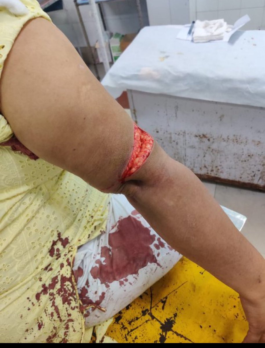 दिल्ली के दिलशाद गार्डन का LAW & ORDER दिल्ली विश्वविद्यालय की प्रोफ़ेसर के साथ स्नैचिंग की कोशिश महिला ने विरोध किया तो धारदार हथियार से किया जानलेवा हमला। @CPDelhi @DCP_SHAHDARA
