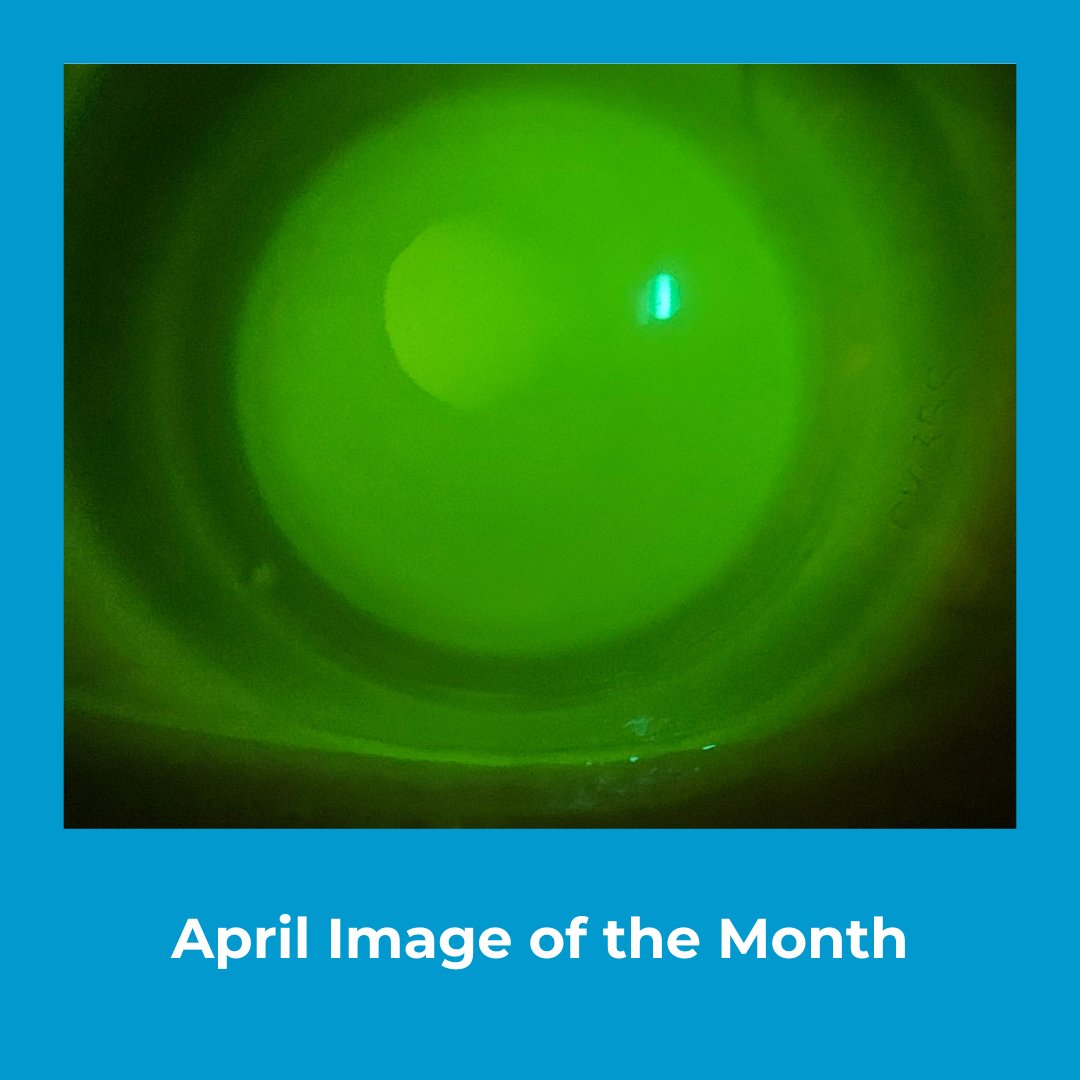 📸 April's Image of the Month by Prasad Sawant: Keratoconus treated with hybrid lenses for clear, comfortable vision

#ClinicalImage #ImageOfTheMonth #ContactLensEducation #ContactLenses #IACLE