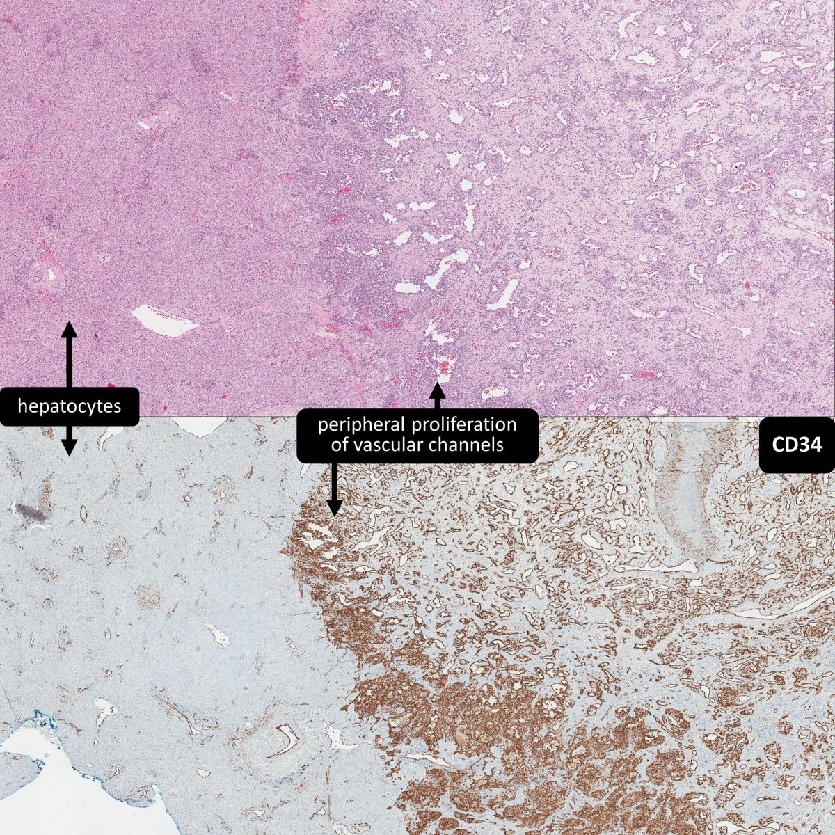 2-month-old 👶with___ of the liver
A) Infantile hemangioma
B) Embryonal sarcoma
C) Mesenchymal hamartoma
#GIPath #PathTwitter #BSTPath #PediPath #Pathology