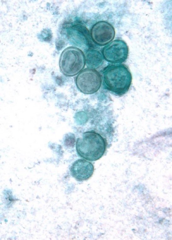A man in his 30s came with fever, cough, dyspnea after returning from Ohio. No improvement despite being on broad spectrum antibiotics. BAL showed broad based budding yeast. What is the diagnosis and treatment? #MedX (image Wikipedia, Health jade)