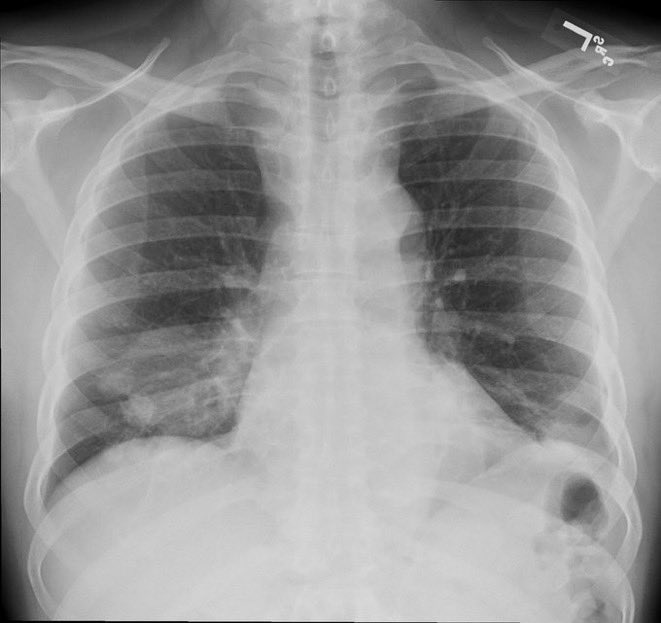 A patient with history of leukemia presented with fever & cough. She mentioned having a pet pigeon at home. No improvement despite being on antibiotics. What is the likely diagnosis? (image @Radiopaedia, Aws Hamid) #MedEd