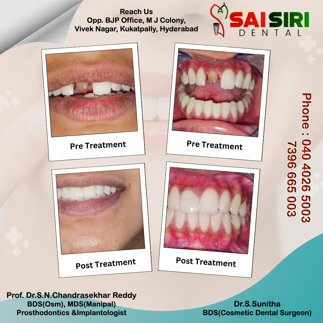 Best Dental Hospital In Kukatpally. #kukatpally #kphb #kphbcolony #kukatpallydoctors #kukatpallyhyderabad #dentists #kukatpallydentist #dentistsofinstagram #kphbcolonyrunners #teethwhitening #saisiridental #kukatpallyhyderabad #pragathinagar #kukatpallyfoodlovers #nizampet