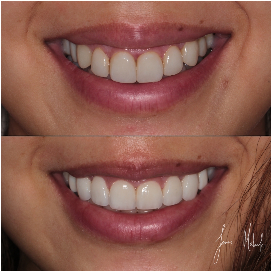 Another amazing Smile Transformation 😍

This patient wanted to update and refresh her smile. @drjamesmalouf removed the old veneers and restored this smile with new hand-made, layered #porcelainveneers to improve the shade & design of the smile! 😁

#drjamesmalouf #maloufdental