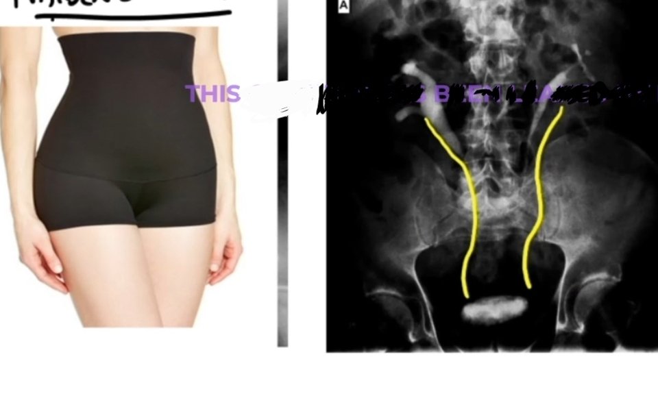 maidens waist Anomaly Seen in?
spot the diagnosis?

#NEETUG #NEET #USMLE #MedX #medicine #MEDebate