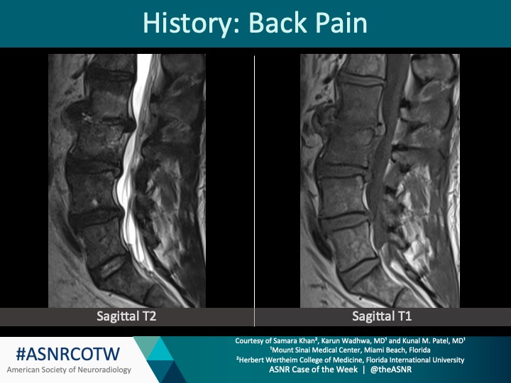 ASNR COTW #194 Hx: Back pain NO SPOILERS! Give hints in the form of GIFs or answer attached poll. Answer in 24 hours. #neuro #neurorad #erad #radres #FOAMed #FOAMrad #medtwitter #ASNRCOTW