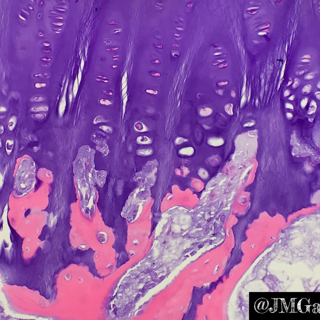 What process is happening here? How old is this patient? 
Answers & pics w labels: kikoxp.com/posts/20899 
Video explanation (at 9:00): kikoxp.com/posts/4166 
#BSTpath #pathologists #pathology #pathTwitter #histology #orthotwitter #pedstwitter #medtwitter