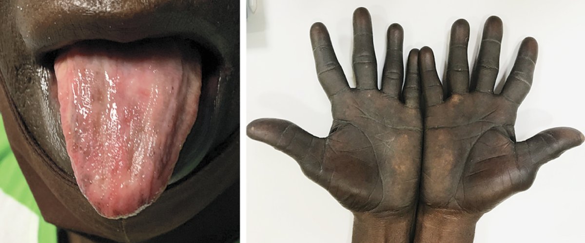 A 59 y/o with fatigue and 1 year of skin darkening on his palms and soles and smooth tongue. He had hemoglobin level of 9.4 g/dL, MCV 117 fL, and mild leukopenia and thrombocytopenia. - What's the diagnosis ? ➡️Full Case and Answer: manualofmedicine.com/spot-diagnosis… #medtwitter #foamed