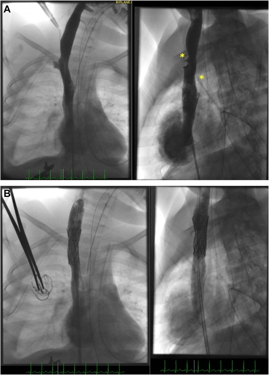 In this #CaseReport, @volley_doc et al. present a unique case of using an endovascular covered stent implantation for vessel hemostasis after extravascular central venous line insertion in a critically ill child 👉cjcpc.ca/article/S2772-… #CJCPC