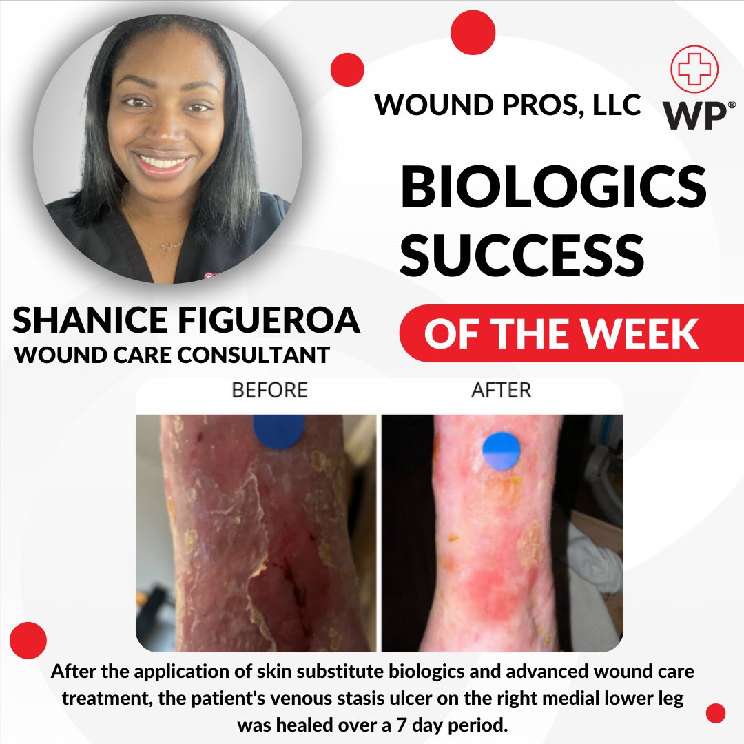 We would like to highlight our Biologics Success of the Week: Shanice Figueroa

Thank you for what you do. We appreciate you!

#woundcare #woundcaretips #woundhealing #wound #woundhealth #health #healthcare #healthservices #digitalhealth #healthprofessionals #healthcareprofes ...