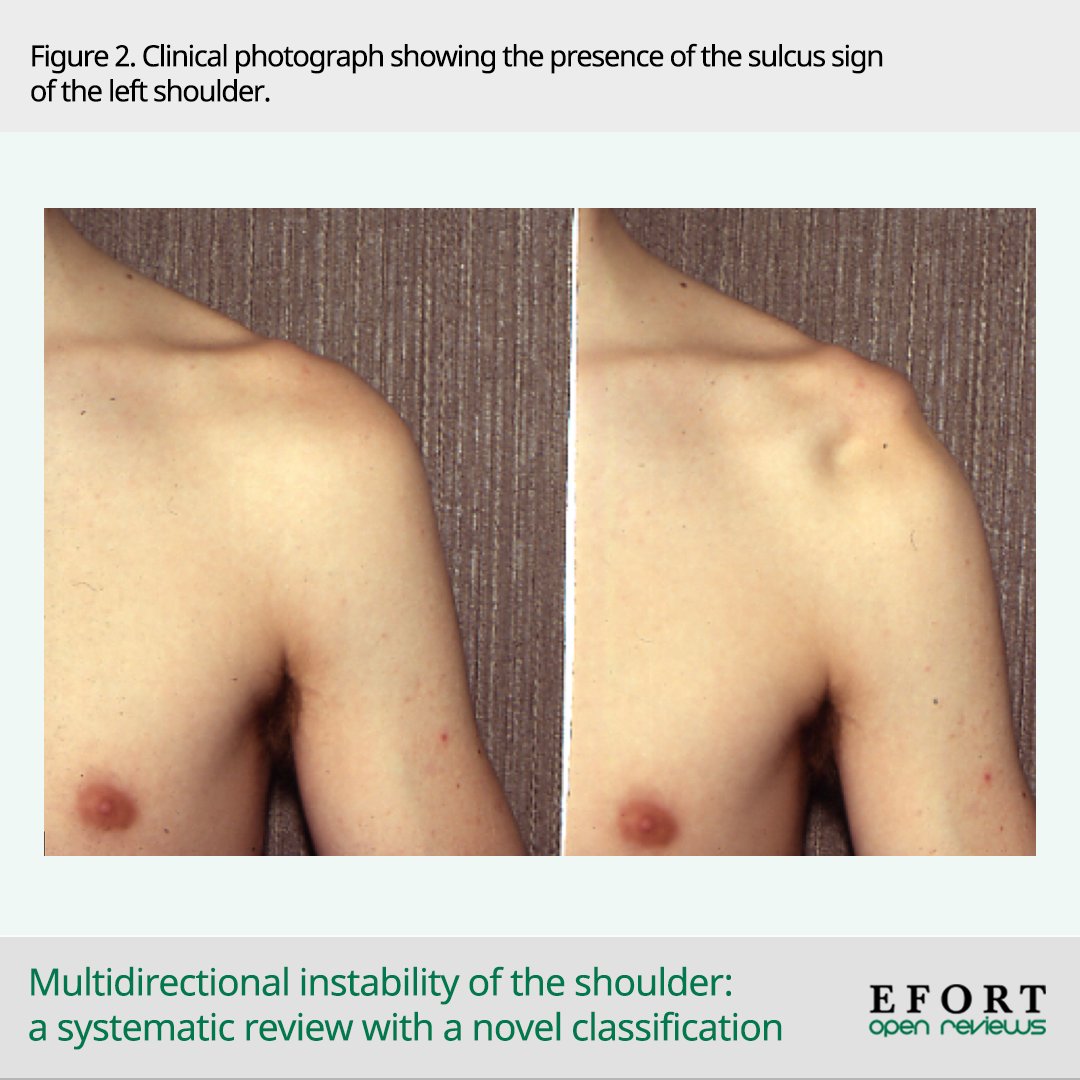 #MDI is defined as symptomatic #instability of #shoulder joint in 2 or + directions. A comprehensive classification system that considers predisposing #trauma & presence of #hyperlaxity can provide a more precise assessment of subtypes 📄 bit.ly/3xY10OW #OpenReviews