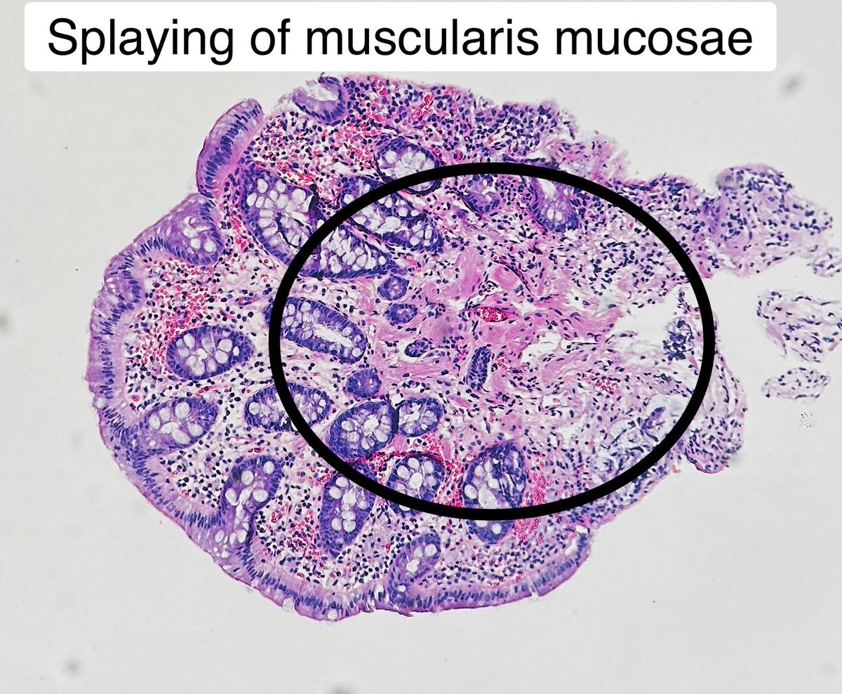 A colonoscopy was done. A small 0.2 cm rectal polyp was found. Multiple levels were done and the only finding: Prolapse type change May be seen in low fiber diets/constipation. #pathagonia #path4people #pathx #gipath #colonoscopy #medstudent #gastroenterology #pathtwitter