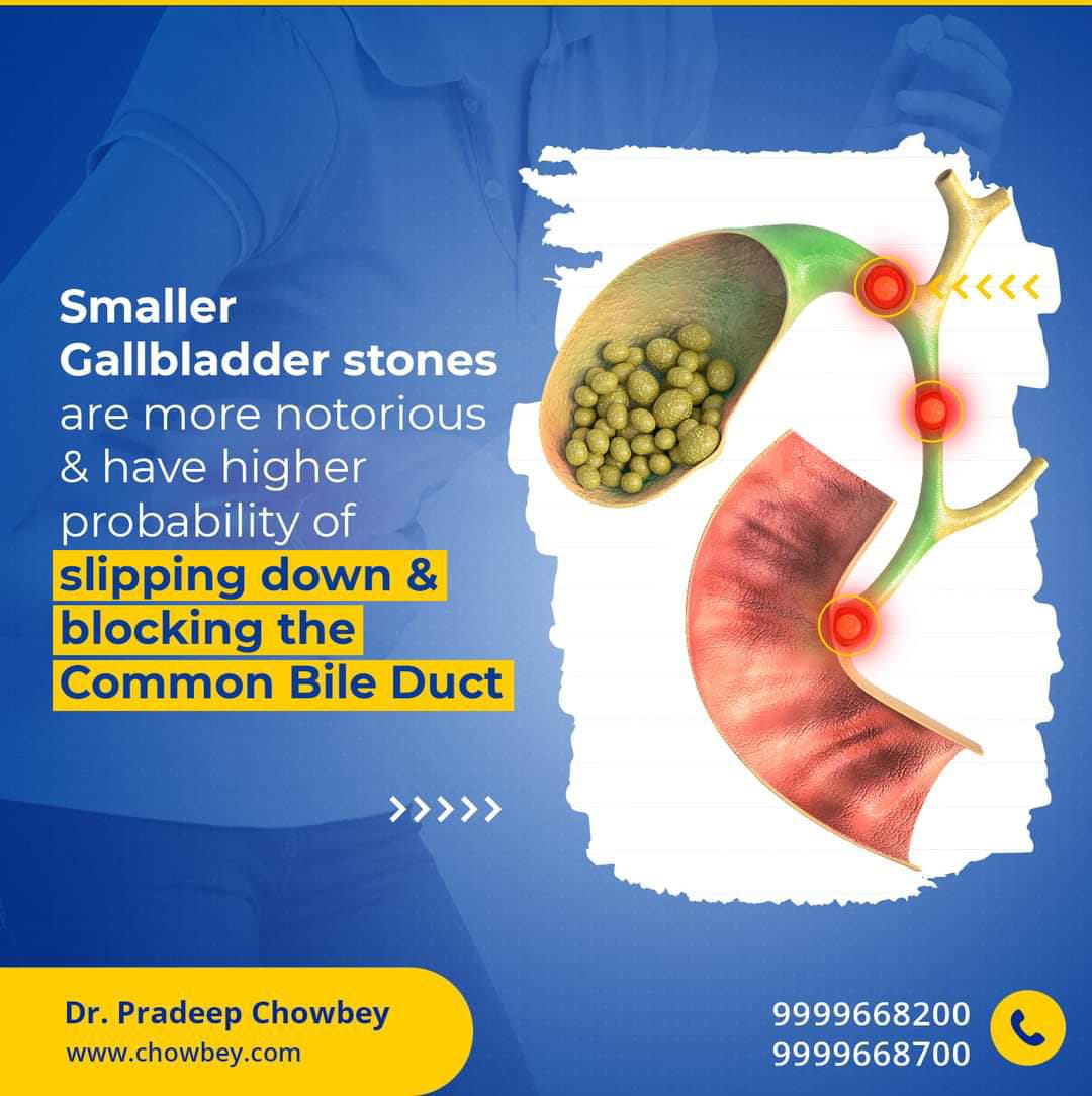 Smaller Gallbladder stones are more notorious & have higher probability of slipping down & blocking the Common Bile Duct.
#gallstones #DoNotIgnore