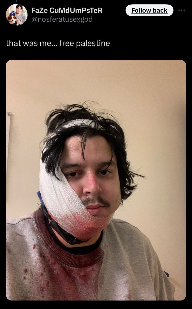 SanaSaeed's tweet photo. This is what those rubber bullets are doing to UCLA students - he was shot in the face. https://t.co/1kfLsdrybp