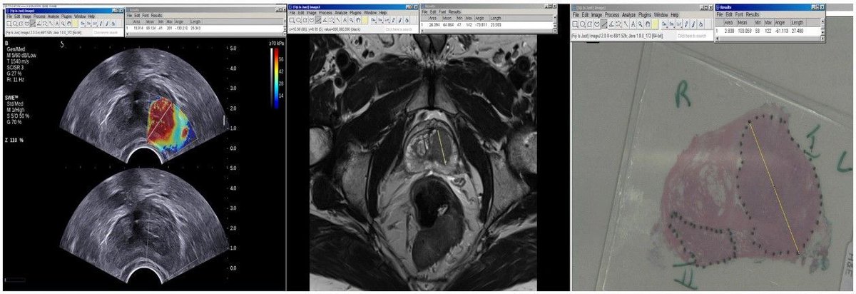 Wael Ageeli et al. found that preoperative imaging using mpMRI significantly underestimated the size of #ProstateCancer in men who underwent radical prostatectomy in comparison to US shear wave elastography (USWE). (@GhulamN2002)

#InsightsIntoImaging

🔗 buff.ly/3UzB4Sk