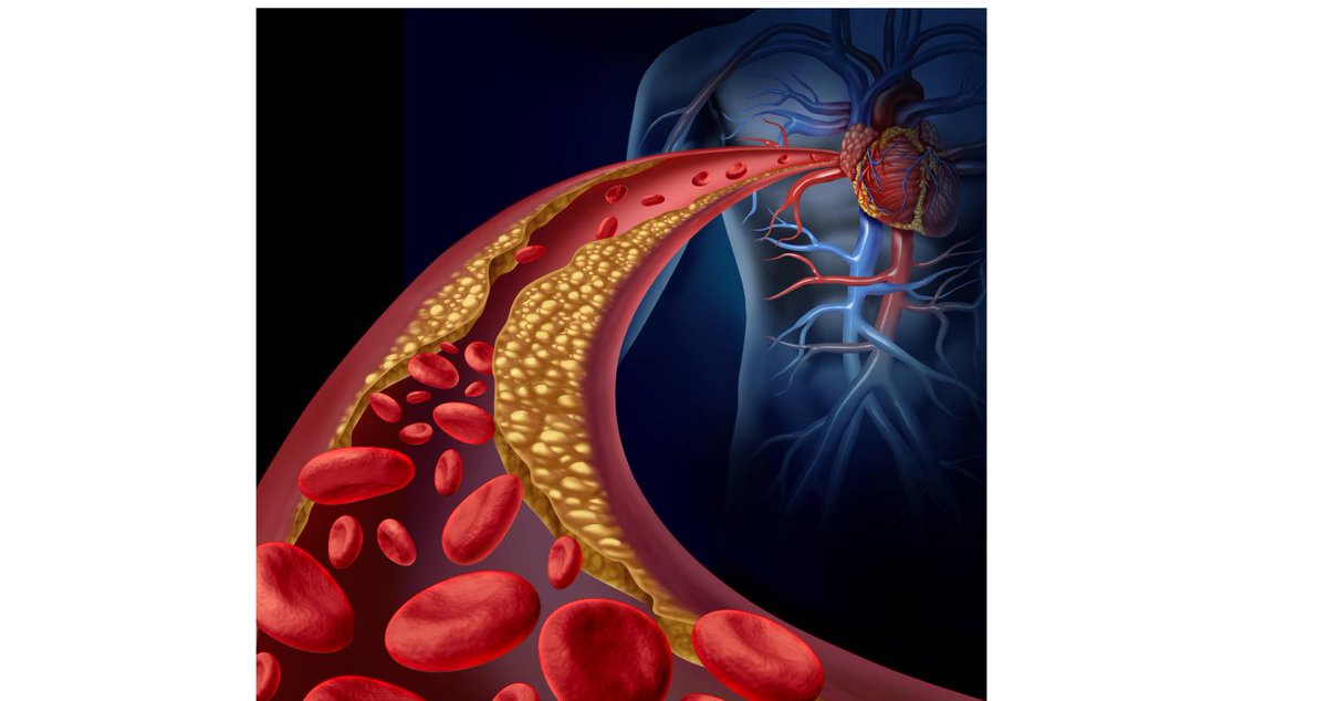 There's a third type of cholesterol known as #lipoprotein(a) – Lp(a) – which is genetically inherited and could be an independent risk factor for heart disease. Should you get your levels of Lp(a) tested? Learn more. bit.ly/3UIBNky