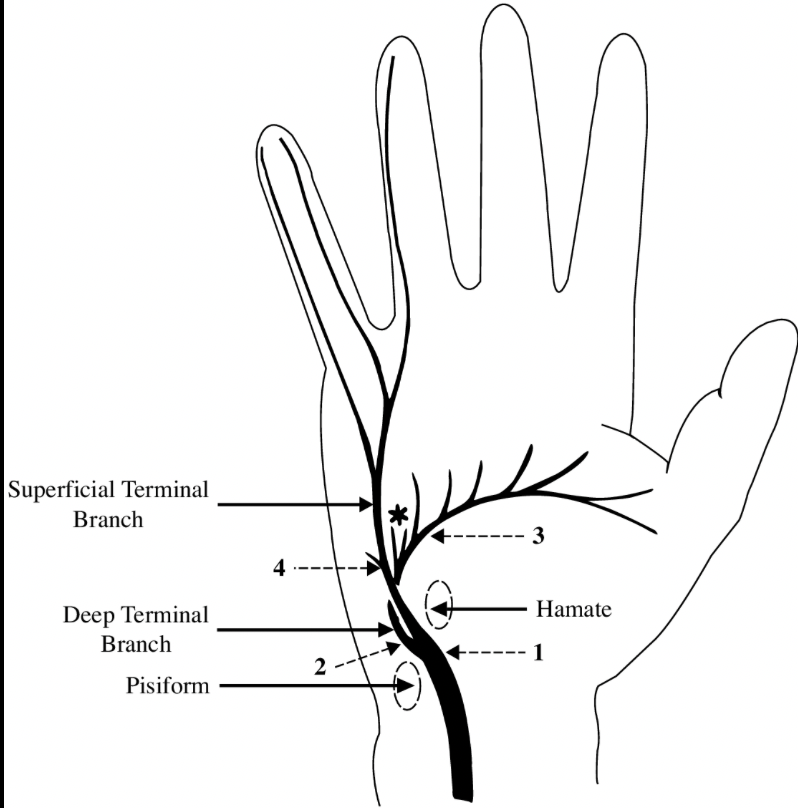 Ulnar neuropathy 'at the wrist' is really in the hand. Guyon's canal is between the pisiform and hamate bones. It's close to the wrist, though.

The numbers in this image are the Zones where injuries can take place, and they each create a unique clinical picture. #tweetorial 
1/6