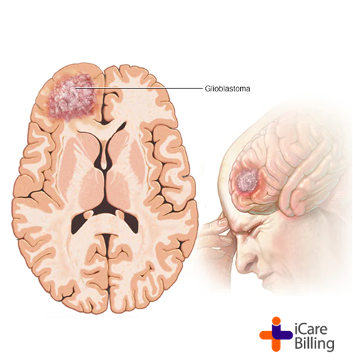 A malignant brain tumour is a cancerous growth in the brain. It's different from a benign brain tumour, which isn't cancerous and tends to grow more slowly.The average glioblastoma survival time is 12-18 months. #icarebilling, an American #HealthcareIT company