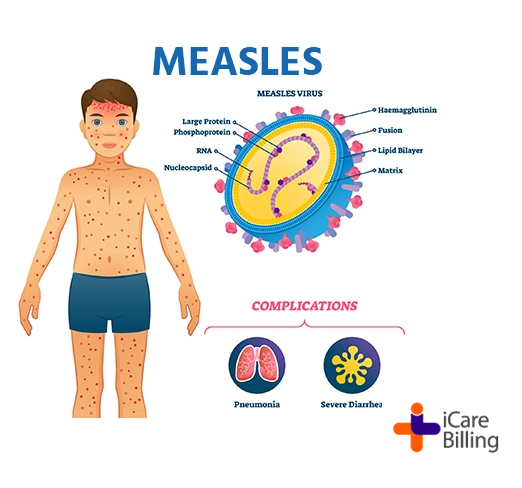 Measles infects the respiratory tract throughout the body. Symptoms include a high fever, cough, runny nose and a rash all over the body. Being vaccinated is the best way to prevent getting sick with measles or spreading it to other people. #icarebilling, the best #RCM Company