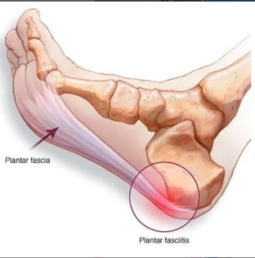 Pain after a long period of rests and after exercise or long walks are some of the negative impacts of plantar fasciitis...
#Podiatrist
// 084 619 7639/ 010 447 1251