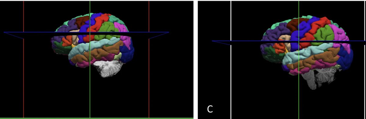 Integrating #MRI brain scans with lifestyle management measures, including #diet, shows promise in understanding #MultipleSclerosis disease outcomes in #Australian study.