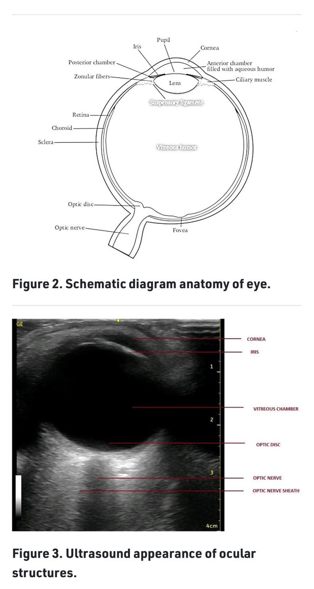 🩺 Hari (హరి 🇮🇳) Kalagara (@kalagarahari) on Twitter photo #POCUS #ASRAPOCUS
💥Check out <a href="/ASRA_Society/">ASRA Pain Medicine</a> latest POCUS Spotlight on 👁️.
👀 #ONSD #opticnerve #ICP
👉 asra.com/news-publicati… Thx 🙏 <a href="/8566288d9abc491/">Dr Amit Dikshit</a> <a href="/drarunangshu/">Arunangshu Chakraborty</a> & Chetan Mehra 🙏 <a href="/AoraIndia/">AORA India</a> 🇮🇳 <a href="/ESRA_Society/">ESRA | European Society of Regional Anaesthesia</a> <a href="/ASALifeline/">ASA®</a> <a href="/SNACCNeuro/">SNACC</a> <a href="/SCCM/">SCCM</a> <a href="/isccmnational/">ISCCM</a> <a href="/NarouzeMD/">Samer Narouze,MD,PhD,MMM</a> #eye #POCUS #ASRAPOCUS
💥Check out <a href="/ASRA_Society/">ASRA Pain Medicine</a> latest POCUS Spotlight on 👁️.
👀 #ONSD #opticnerve #ICP
👉 asra.com/news-publicati… Thx 🙏 <a href="/8566288d9abc491/">Dr Amit Dikshit</a> <a href="/drarunangshu/">Arunangshu Chakraborty</a> & Chetan Mehra 🙏 <a href="/AoraIndia/">AORA India</a> 🇮🇳 <a href="/ESRA_Society/">ESRA | European Society of Regional Anaesthesia</a> <a href="/ASALifeline/">ASA®</a> <a href="/SNACCNeuro/">SNACC</a> <a href="/SCCM/">SCCM</a> <a href="/isccmnational/">ISCCM</a> <a href="/NarouzeMD/">Samer Narouze,MD,PhD,MMM</a> #eye