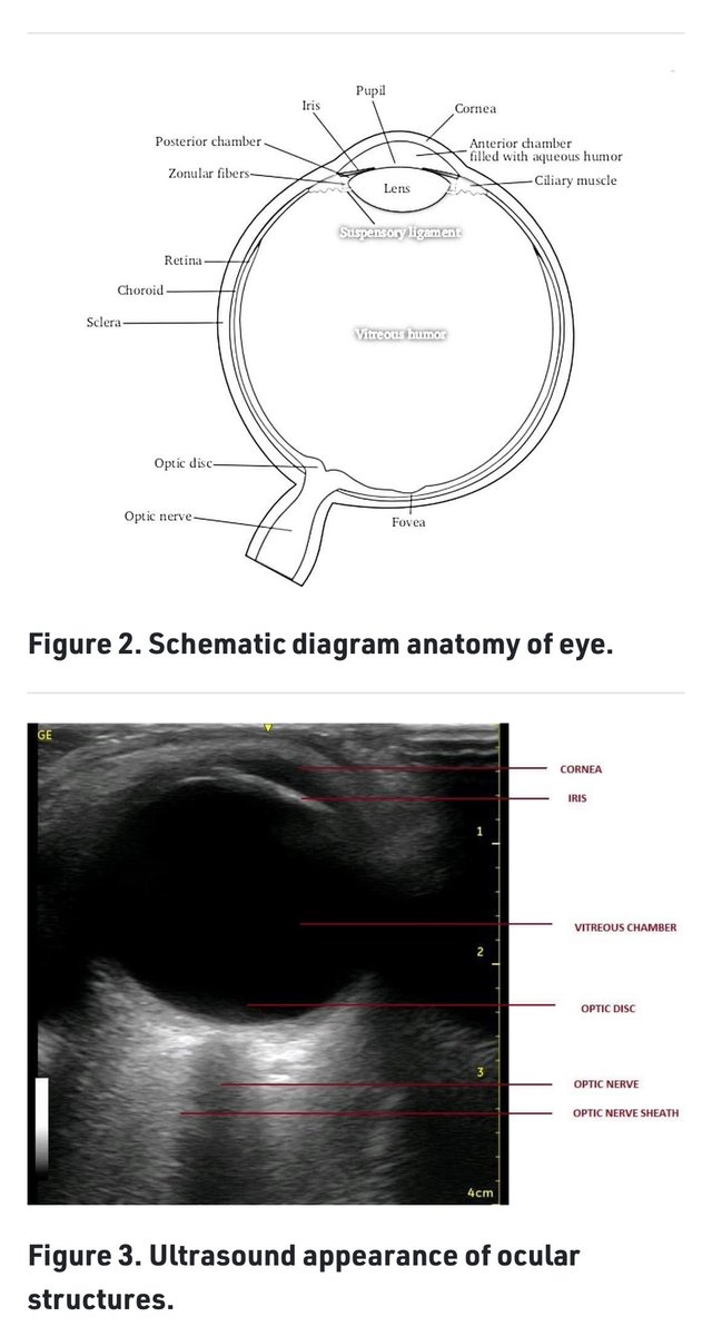 #POCUS #ASRAPOCUS 
 💥Check out @ASRA_Society latest POCUS Spotlight on 👁️.
👀 #ONSD #opticnerve #ICP
👉 asra.com/news-publicati…  Thx 🙏 @8566288d9abc491 @drarunangshu & Chetan Mehra 🙏 @AoraIndia 🇮🇳 @ESRA_Society @ASALifeline @SNACCNeuro @SCCM @isccmnational @NarouzeMD #eye