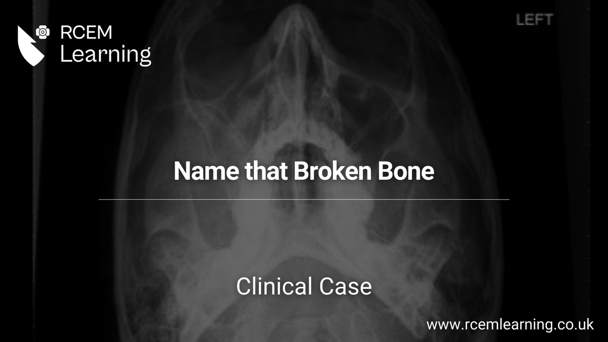 UPDATE: This 18-year-old patient was allegedly punched by a stranger during a night out. He presents with marked facial swelling and numbness over his right cheek. Read more of our #ClinicalCase here: rcemlearning.co.uk/modules/name-t…