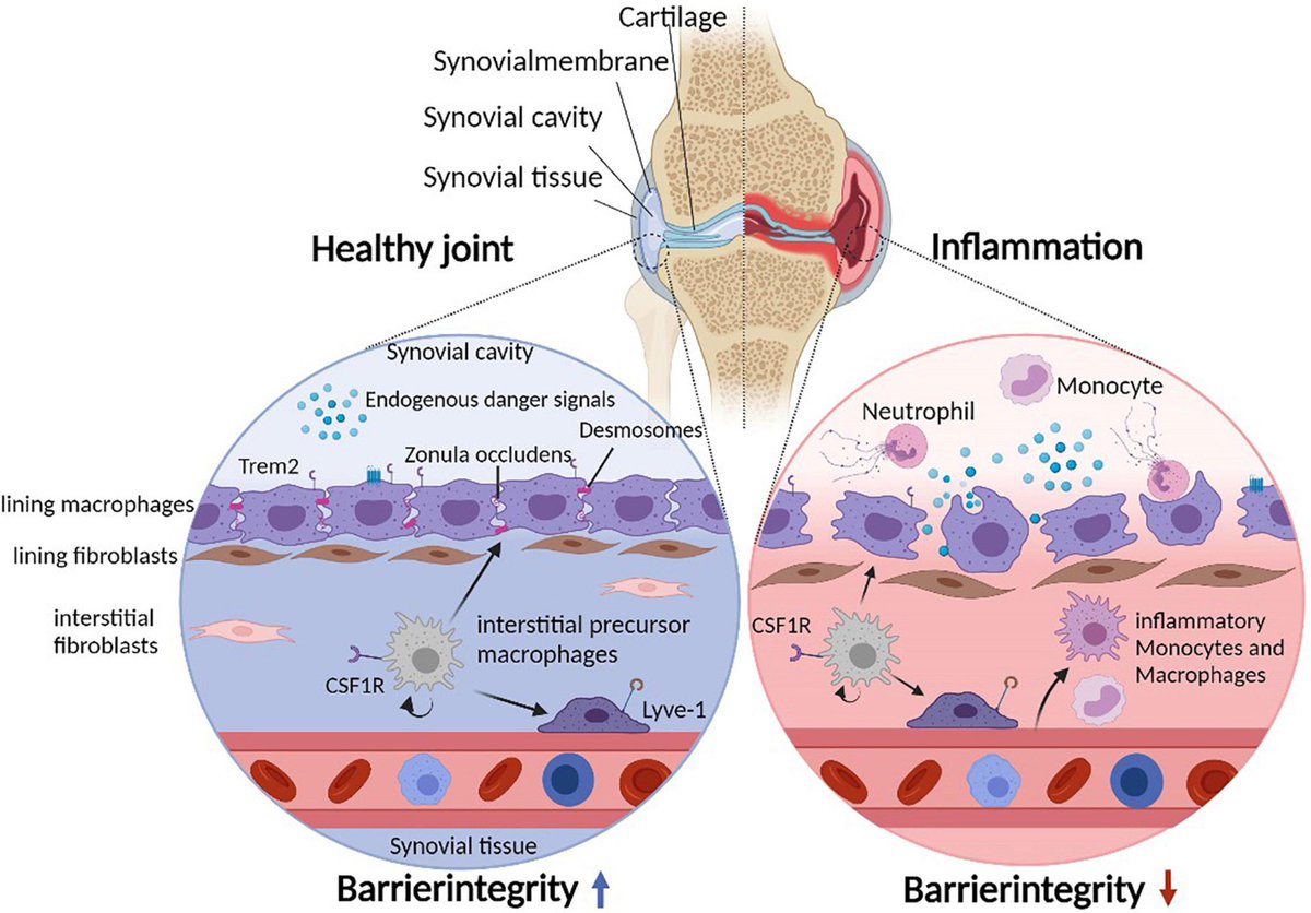 ✨How Low-Dose Radiation Therapy Helps Relieve Pain and Improve Function in Joints

Low-dose radiation therapy (LDRT) has shown promising results in relieving pain and improving function in patients with osteoarthritis. Here's a breakdown of how it works:

👉Targeting…