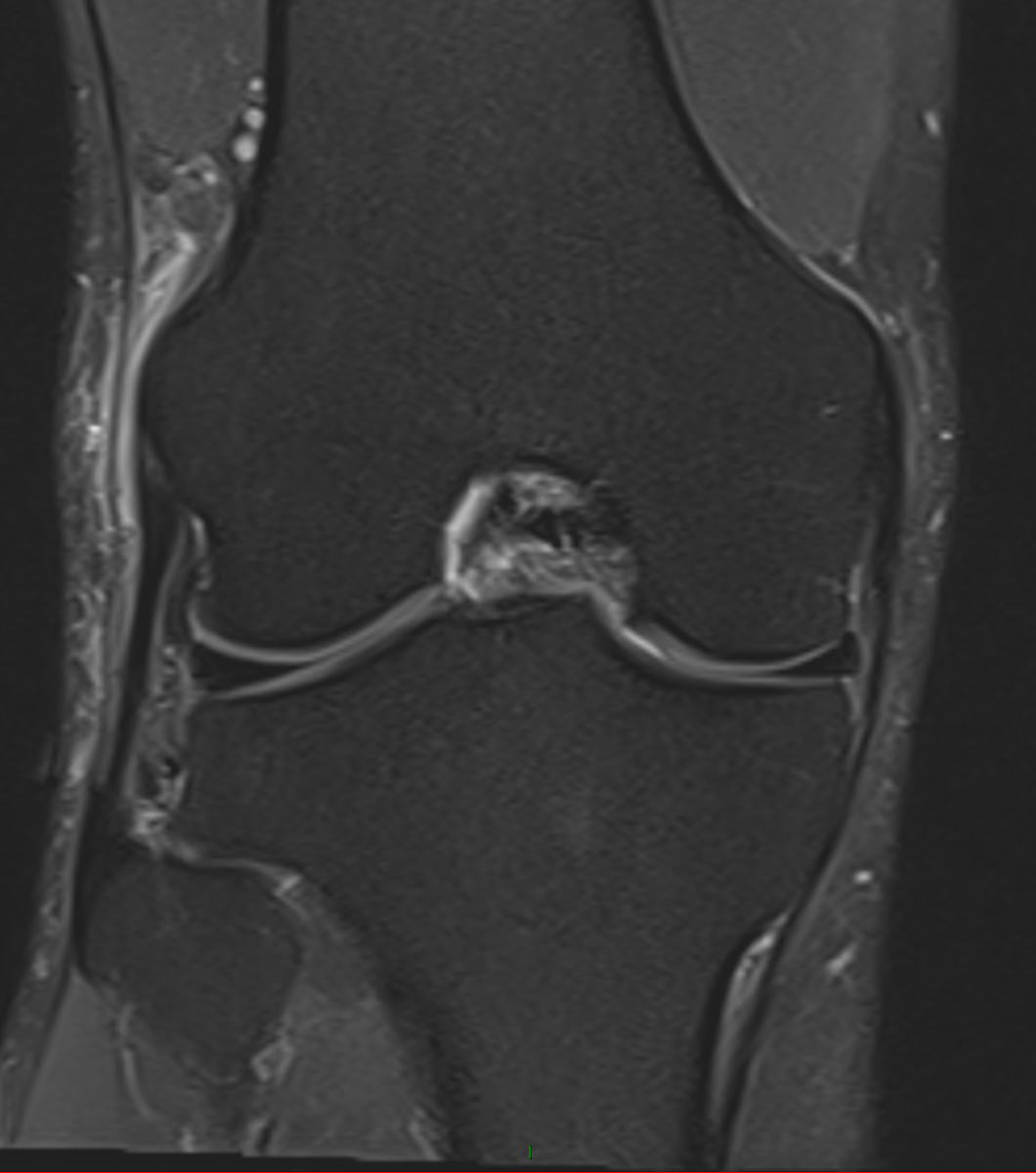 Recreational Cyclist. Lateral knee pain. Iliotibial band syndrome: High signal in STIR due to Inflammation of the fat adjacent to the iliotibial band.