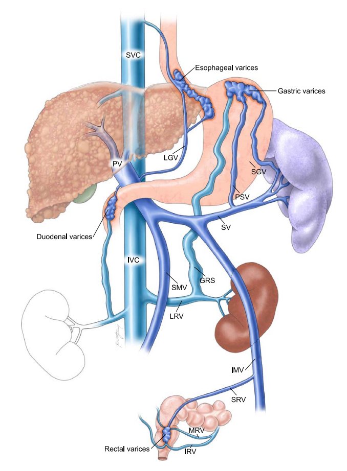 Portal hypertension and varices in relation to venous anatomy, from the recent AASLD guideline on the management of variceal hemorrhage: doi:10.1097/HEP.0000000000000530