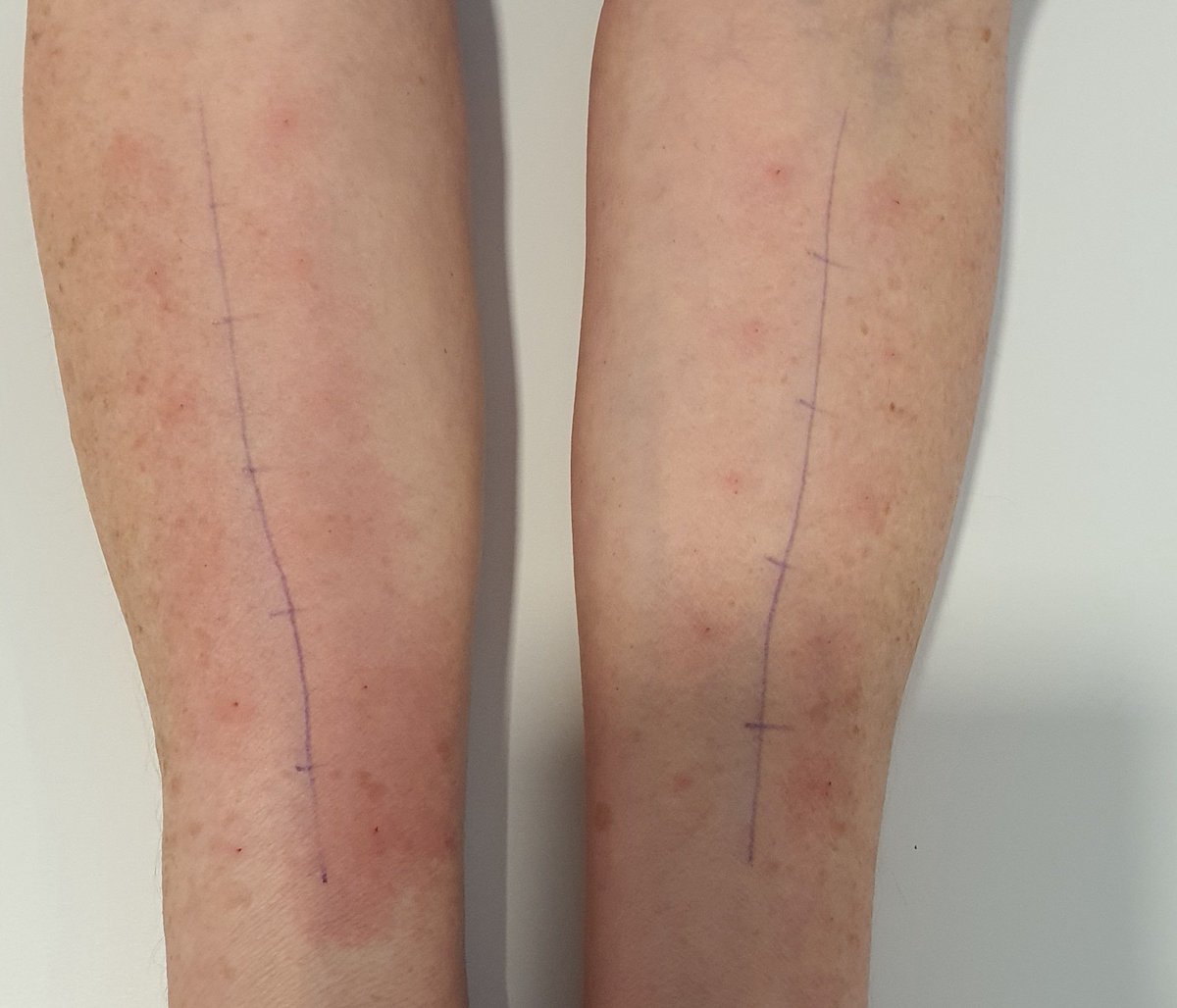 Teilhabe_4_all's tweet photo. Liebe FreundInnen der #Blühwiese. So siehts aus! #Allergietest noch genauso wie vor 40 Jahren. Einige Dinge ändern sich nie. https://t.co/K2pfUQNiom