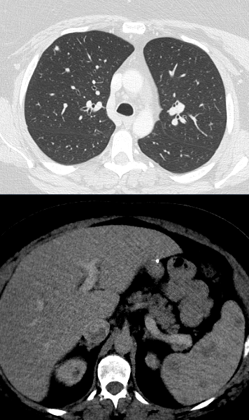 What's your diagnosis? 

#meded #radiology #abdrad #abdomen #imaging