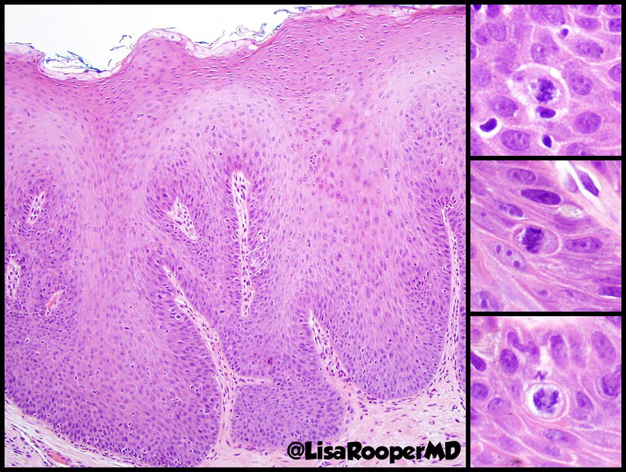 @IhabFathiSulima Focal epithelial hyperplasia/Heck disease. Acanthotic squamous epithelium with widened, confluent rete ridges mild koilocytic change, and mitosoid bodies (degenerating nuclei mimicking mitoses). 
Usually caused by HPV