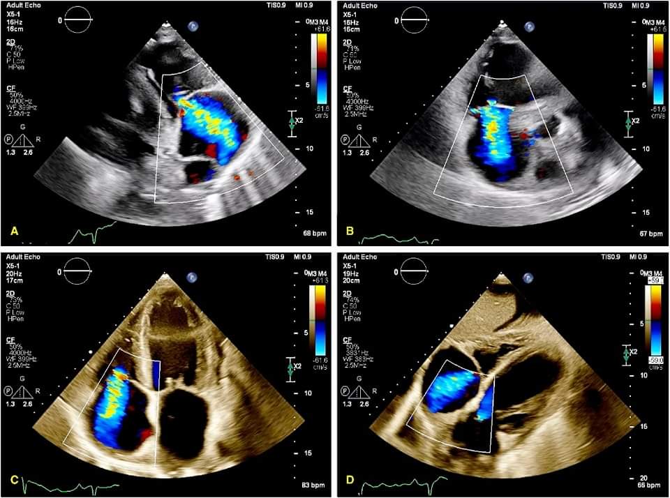 🔴Tricuspid Regurgitation: A Review of Current Interventional Management #oppenaccess #2024Review 

✅What is new in the world of tricuspid regurgitation?

ahajournals.org/doi/10.1161/JA…
#cardiotwiteros #MedEd #cardiology #medtwitter #CardioTwitter #medtwitterwhat #review #2024Review