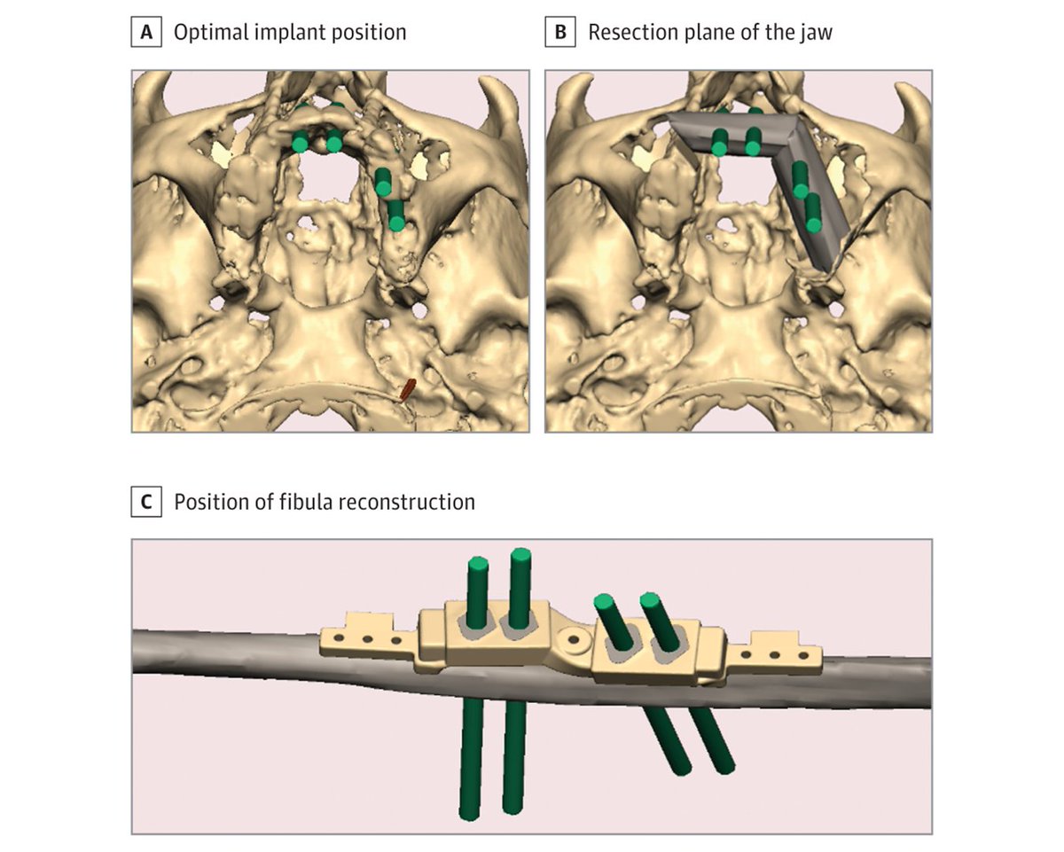 Prefabricated fibular free flaps are as safe, effective, and accurate as bone-driven and delayed osseointegrated implant installation for jaw reconstruction while achieving significantly faster oral rehabilitation (12 vs 60 months). ja.ma/3JMCQJT