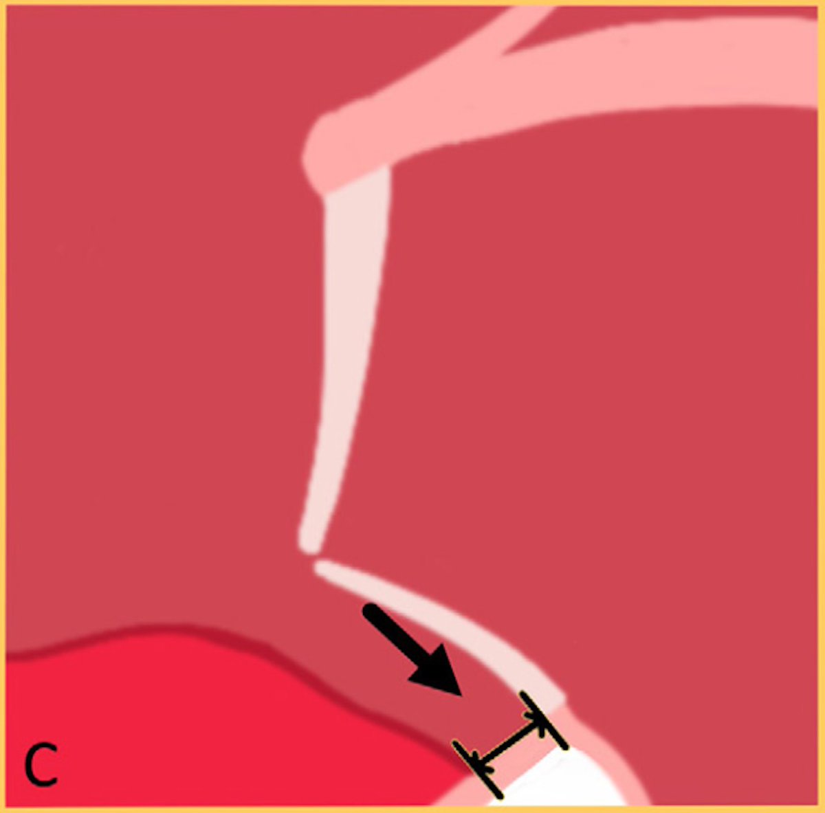 10/13 
❓How can we measure MAD distance❓
 Is the distance between the hinge point in the atrial wall to the top of the basal-LV myocardium.
Image C shows a magnified view of MAD with a caliper measuring MAD distance (black arrow).