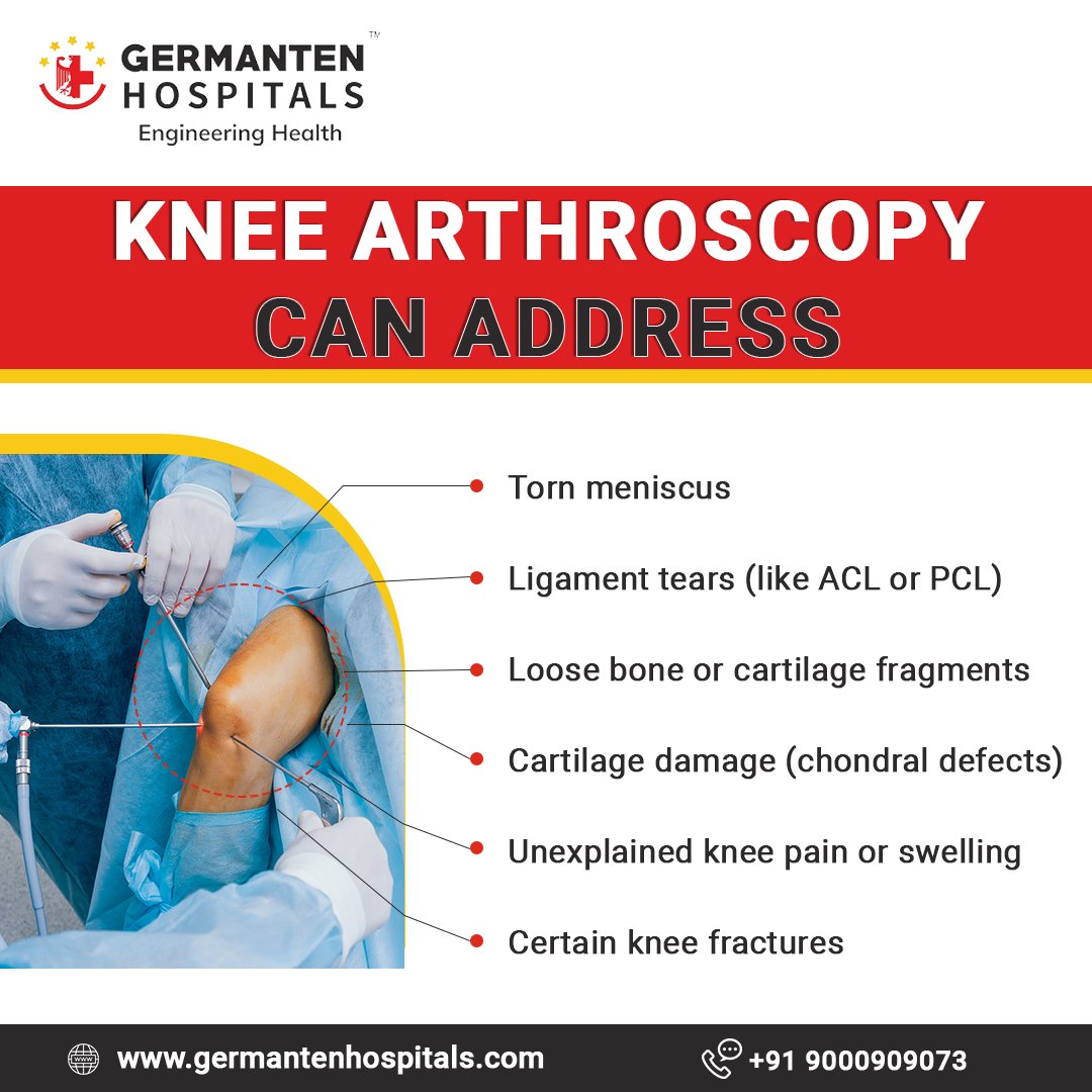 When knee issues arise, knee arthroscopy offers solutions for torn meniscus, ligament tears, and cartilage damage. Find relief and regain mobility with personalized care from our orthopedic experts. 
#kneehealth #orthopedics #surgery #arthritis #germantenhospital