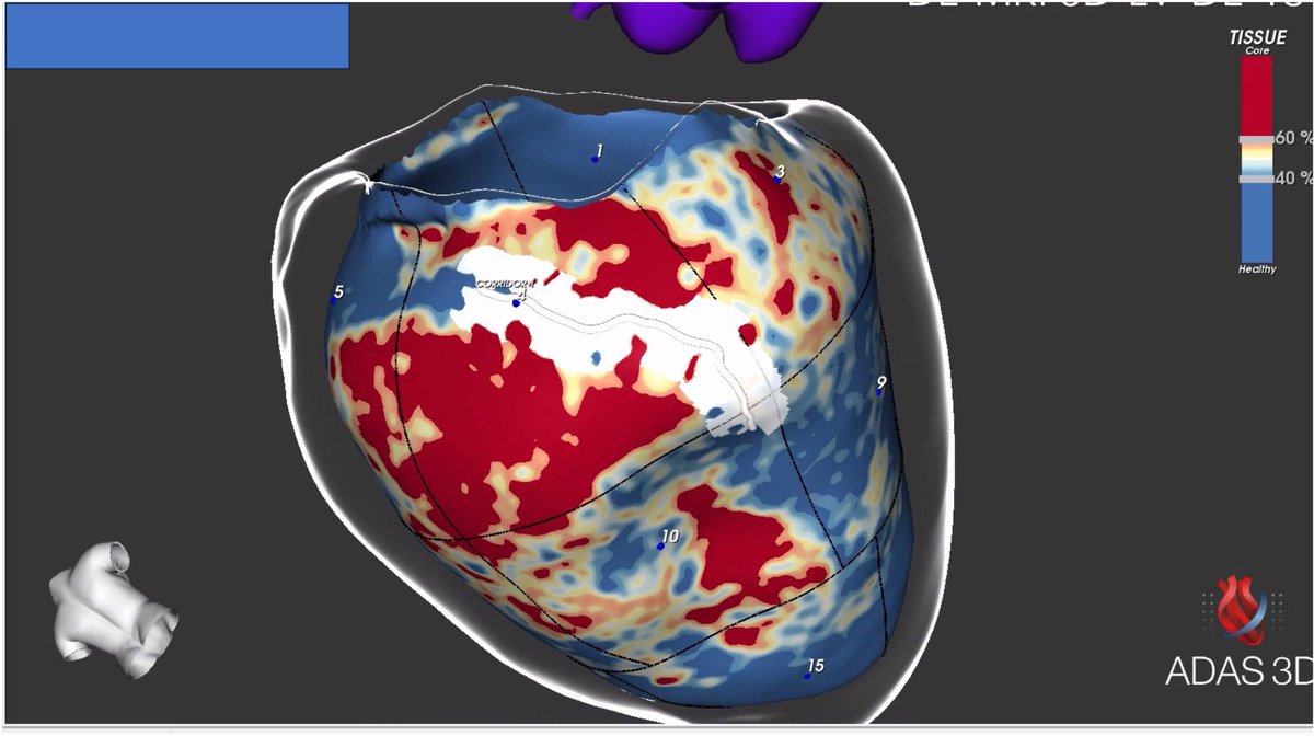 Konstantinos Letsas (@k_letsas) on Twitter photo cMRI-aided VT ablation. Perfect match of the suggested cMRI corridor with VT isthmus (near-field diastolic buffet). Minimal lesions with short procedural time. <a href="/SteliosDragasis/">Stelios</a> <a href="/athsaplaouras/">Athanasios Saplaouras</a> <a href="/ipetemil/">Panagiotis Mililis</a> <a href="/Kariki_O/">Ourania Kariki</a> <a href="/BellosPeriklis/">Periklis Bellos</a> <a href="/eva_nyktari/">Eva Nyktari</a> <a href="/MEfraimidis/">Michail Efremidis</a>
<a href="/ADAS3D/">ADAS3D Medical</a> <a href="/SiemensHealth/">Siemens Healthineers</a> cMRI-aided VT ablation. Perfect match of the suggested cMRI corridor with VT isthmus (near-field diastolic buffet). Minimal lesions with short procedural time. <a href="/SteliosDragasis/">Stelios</a> <a href="/athsaplaouras/">Athanasios Saplaouras</a> <a href="/ipetemil/">Panagiotis Mililis</a> <a href="/Kariki_O/">Ourania Kariki</a> <a href="/BellosPeriklis/">Periklis Bellos</a> <a href="/eva_nyktari/">Eva Nyktari</a> <a href="/MEfraimidis/">Michail Efremidis</a>
<a href="/ADAS3D/">ADAS3D Medical</a> <a href="/SiemensHealth/">Siemens Healthineers</a>